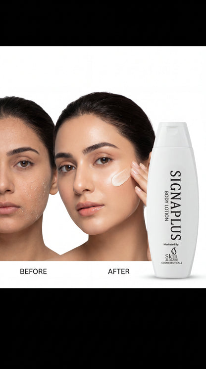 SignaPlus Body Lotion | Urea, Glycerin & Wheat Germ Oil Moisturizer for Dry, Very Dry, Sensitive & Atopic Skin | Deep Hydration & Skin Barrier Repair | 200ml