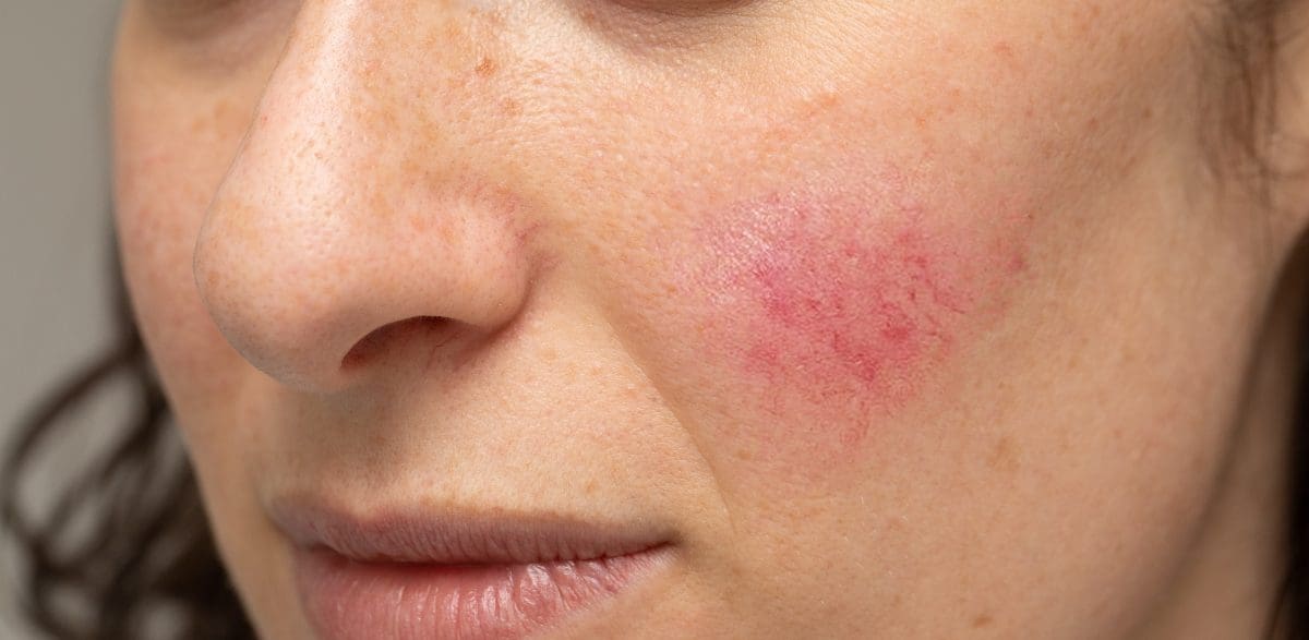 Alliance Rosacea Cream- for redness & spider veins