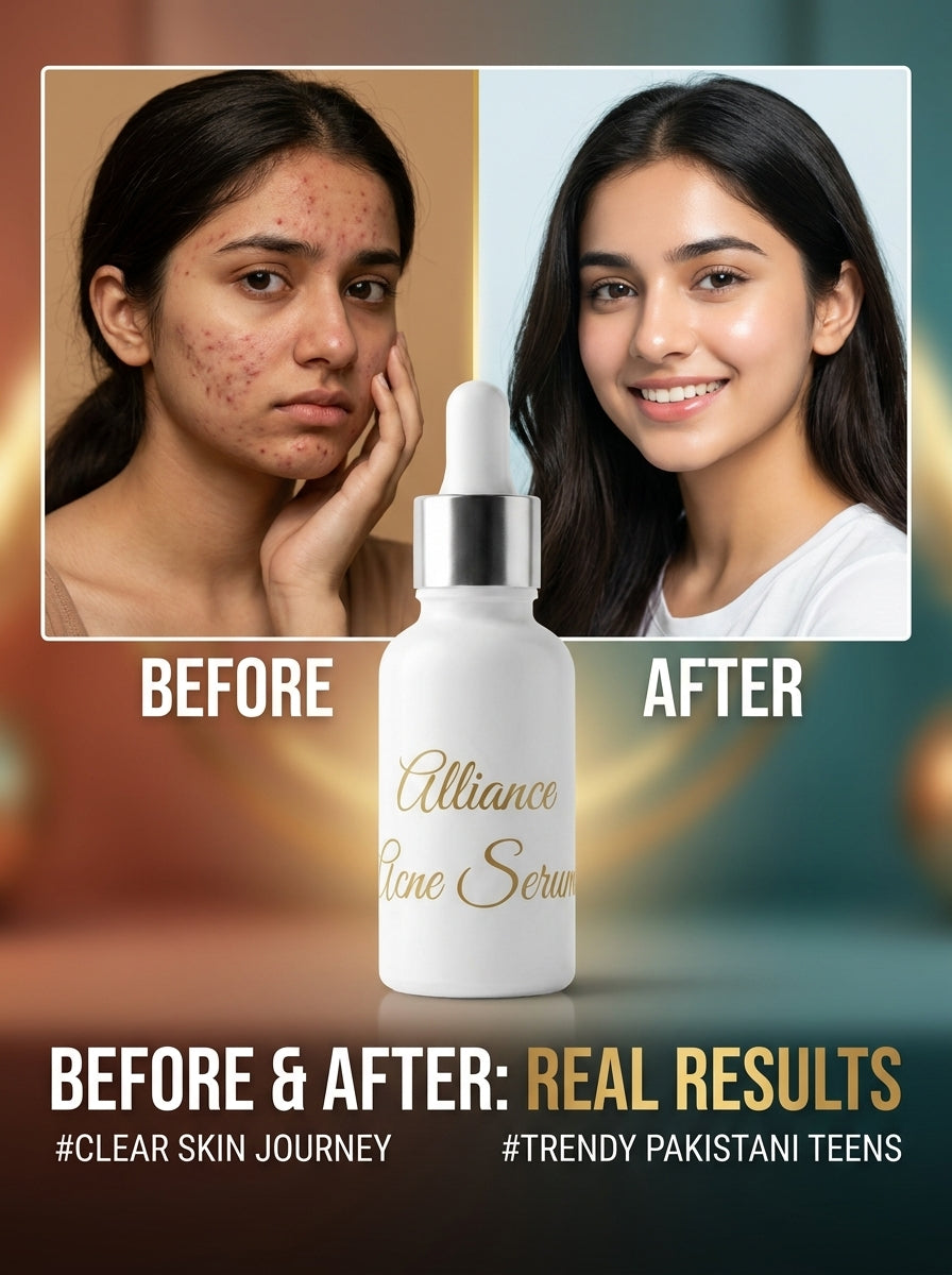 Alliance Acne Control Serum – Anti Acne, Pimple & Acne Marks Treatment Serum