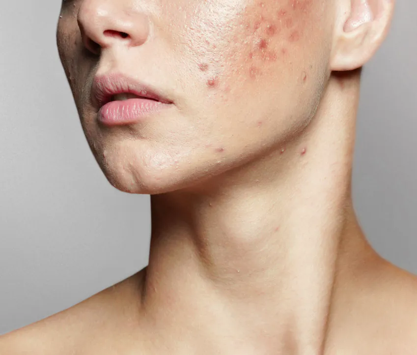 acne treatment in pakistan