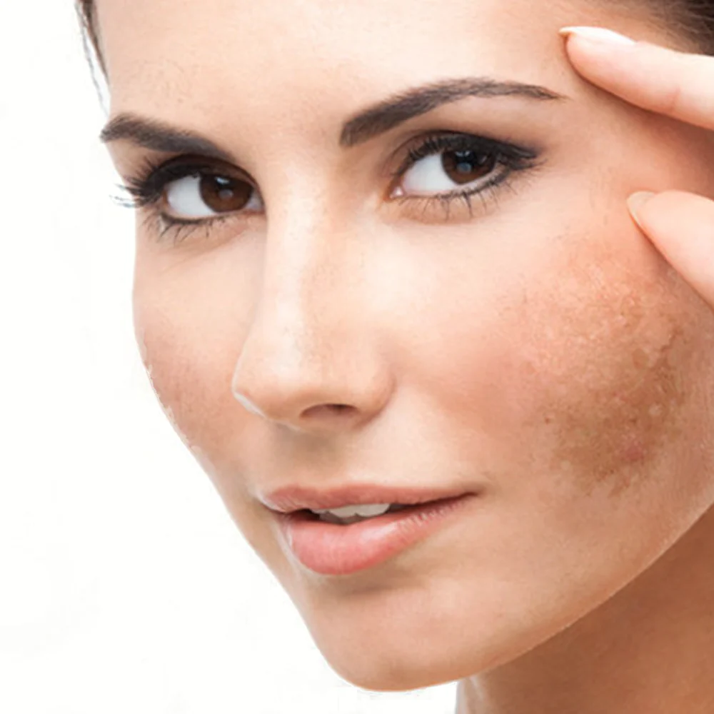 SkinAlliance pigmentation treatment products including Beutera serum, StayOn cream, and Alldayz SPF100 sunblock against a cream and gold background