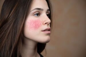 Rosezen Cream: Dermatologist Solution for Spider Veins & Rosacea in Pakistan